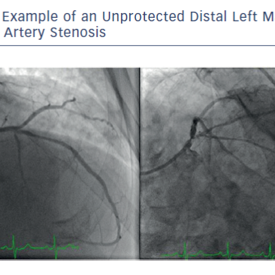 Figure 1 Example of an Unprotected Distal Left Main&ampltbr /&ampgt&amp10Coronary Artery Stenosis