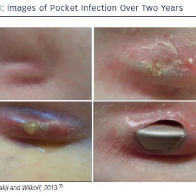 Figure 1 Images of Pocket Infection Over Two Years