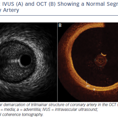 Figure 1 IVUS A and OCT B Showing a Normal Segment of Coronary Artery