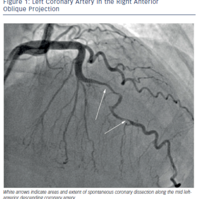 Figure 1 Left Coronary Artery in the Right Anterior Oblique Projection