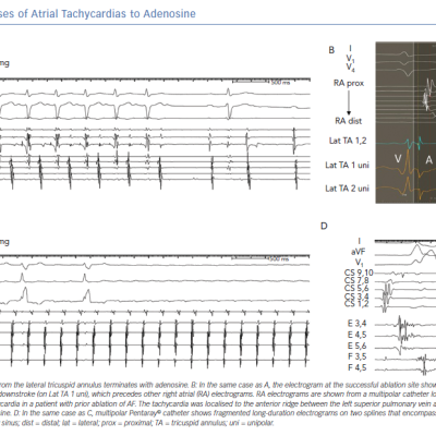 Responses of Atrial Tachycardias to Adenosine