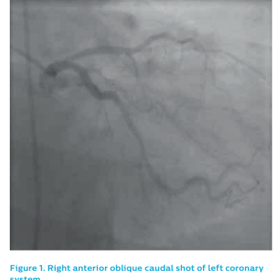 Figure 1. Right anterior oblique caudal shot of left coronarysystem