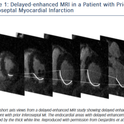 Figure 1 Delayed-enhanced MRI in a Patient
