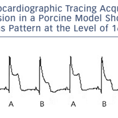 Figure 1. Electrocardiographic Tracing Acquired During Coronary Occlusion in a Porcine Model Showing a Visible T-Wave Alternans Pattern at the Level of 162 µV