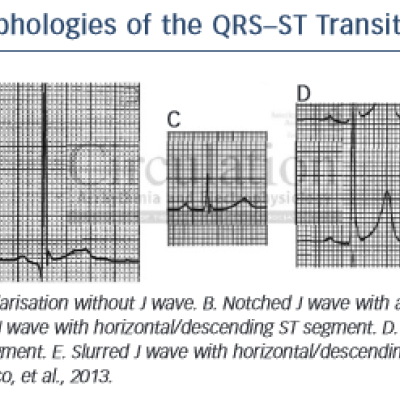 Figure 1 Morphologies of the QRS–ST Transitions