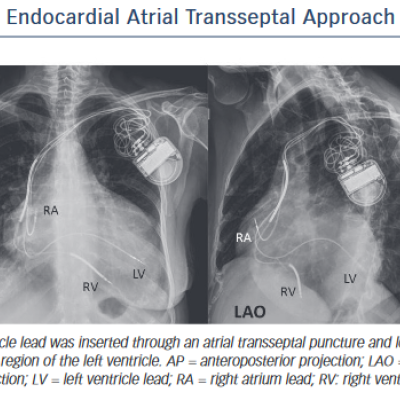 Endocardial Atrial Transseptal Approach