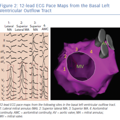 12-lead ECG Pace Maps from the Basal Left Ventricular Outflow Tract