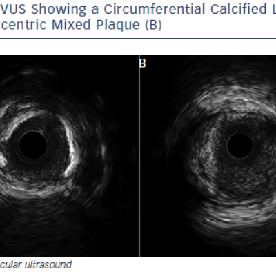 Figure 2 IVUS Showing a Circumferential Calcified Lesion A and Eccentric Mixed Plaque B