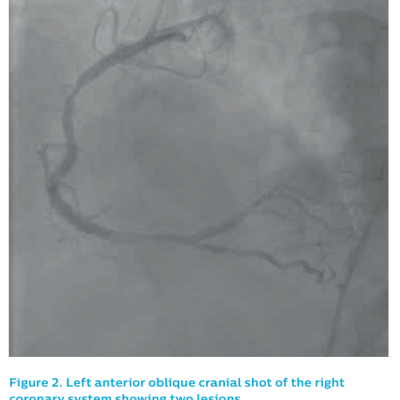 Figure 2. Left anterior oblique cranial shot of the rightcoronary system showing two lesions