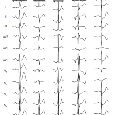 P-morphologies of Focal Atrial Tachycardias