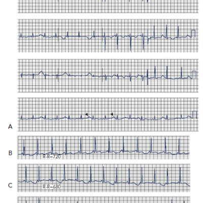 Twelve-lead ECG from a Patient with Hypokalaemia and Hypomagnesaemia
