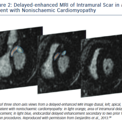 Figure 2 Delayed-enhanced MRI of Intramural Scar in a Patient with Nonischaemic Cardiomyopathy