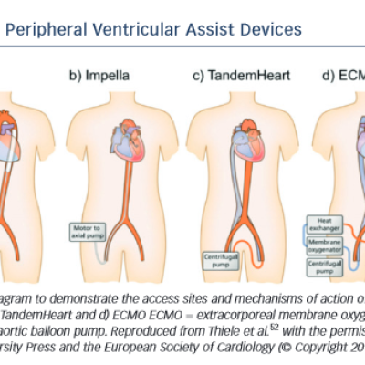 Figure 2 Peripheral Ventricular Assist Devices