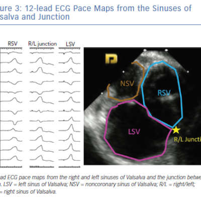 12-lead ECG Pace Maps from the Sinuses of Valsalva and Junction
