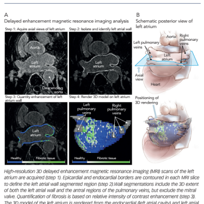 Figure 3 Delayed-enhancement MRI for Quantification of Atrial Fibrosis in Atrial Fibrillation