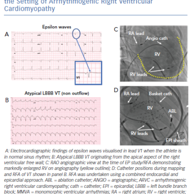 Monomorphic Ventricular Arrhythmias in the Setting of Arrhythmogenic Right Ventricular Cardiomyopathy