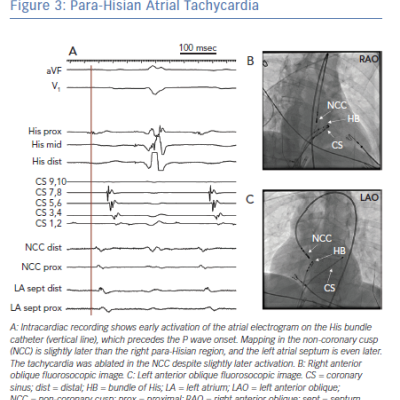 Para-Hisian Atrial Tachycardia