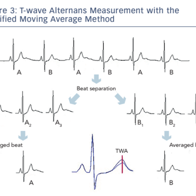 Figure 3 T-wave Alternans Measurement with the Modified Moving Average Method