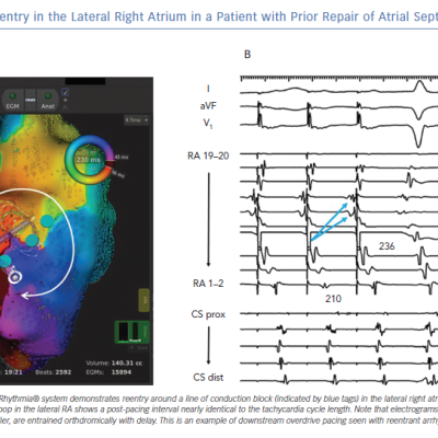 Incisional Reentry in the Lateral Right Atrium in a Patient with Prior Repair of Atrial Septal Defect