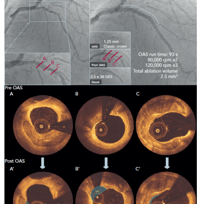 Typical Case Example of Angiography and Optical Coherence Tomography Images Pre- and Post-orbital Atherectomy