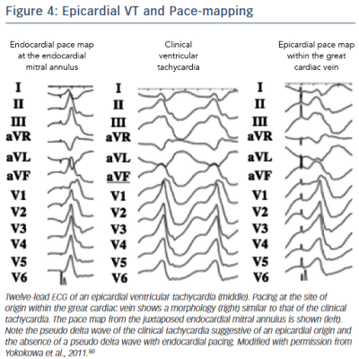 Figure 4 Epicardial VT and Pace-mapping