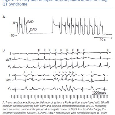 Early and delayed afterdepolarizations in Long QT Syndrome