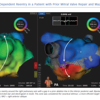 Left Atrial Roof-Dependent Reentry in a Patient with Prior Mitral Valve Repair and Maze Procedure