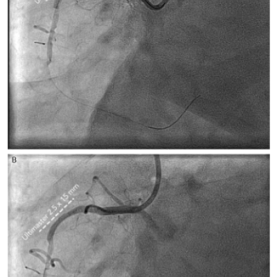 RCA Proximal Occlusion to Implanted Stent