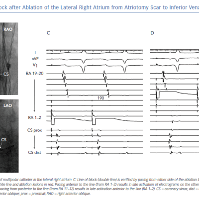 Line of Block after Ablation of the Lateral Right Atrium from Atriotomy Scar to Inferior Vena Cava