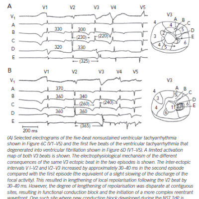 Isochronal Maps of Nonsustained and Sustained Ventricular Tachyarrhythmia Shown in Figure 6