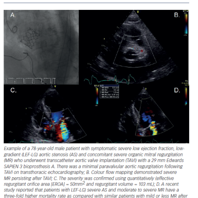 Figure 1 Severe Aortic Stenosis and Severe Organic Mitral Regurgitation