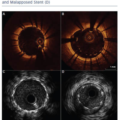 Figure 3 OCT Showing a Well-opposed Stent A and Malapposed Stent B IVUS Showing a Well-opposed Stent C and Malapposed Stent D