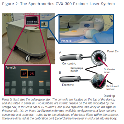 Figure 2 The Spectranetics CVX-300 Excimer Laser System