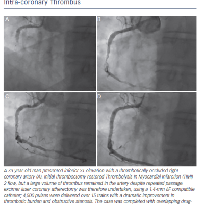 Figure 4 The Use of Excimer Laser Coronary Atherectomy in Intra-coronary Thrombus