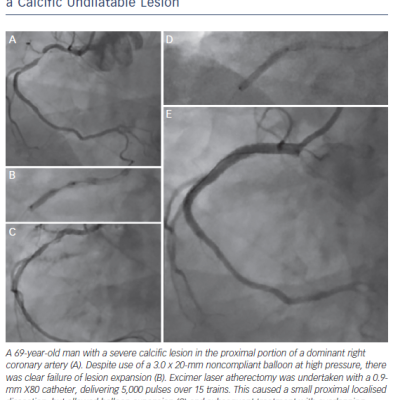 Figure 5 The use of Excimer Laser Coronary Atherectomy in a Calcific Undilatable Lesion
