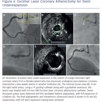 Figure 6 Excimer Laser Coronary Atherectomy for Stent Underexpansion