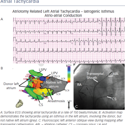 Left Macro-reentrant Scar-related Atrial Tachycardia