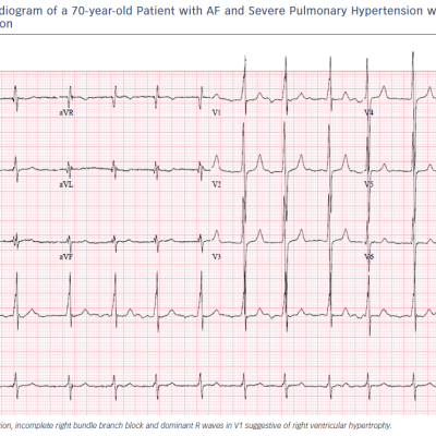 Figure 1 Electrocardiogram of a 70-year-old Patient with AF and Severe Pulmonary Hypertension with Right Ventricular Dilatation/Dysfunction