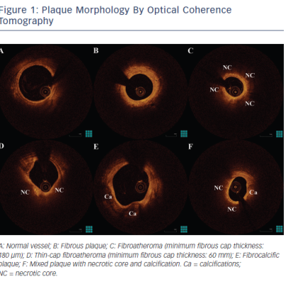 Figure 1 Plaque Morphology By Optical Coherence Tomography