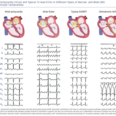 Figure 1 Tachycardia Circuit and Typical 12-lead ECGs in Different Types of Narrow- and Wide-QRS Supraventricular Tachycardias