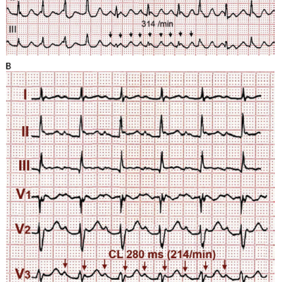 Figure 1 The ECG Pattern May Not Reflect the Mechanism