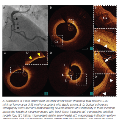 Figure 2 Features of Non-culprit Plaque Vulnerability by Optical Coherence Tomography