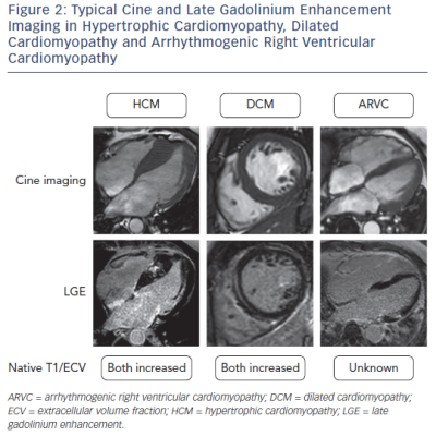 Figure 2 Typical Cine and Late Gadolinium Enhancement Imaging in Hypertrophic Cardiomyopathy Dilated Cardiomyopathy and Arrhythmogenic Right Ventricular Cardiomyopathy