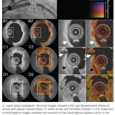 Figure 3 Assessment of Plaque Rupture by Polarisation-Sensitive Optical Coherence Tomography