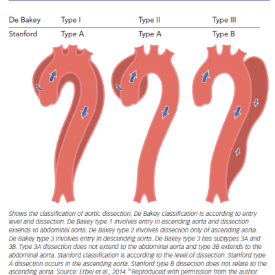 Figure 3 The Classification of Aortic Dissection