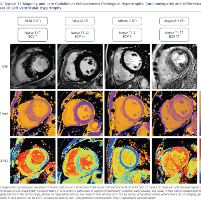 Figure 3 Typical T1 Mapping and Late Gadolinium Enhancement Findings in Hypertrophic Cardiomyopathy and Differential&ampltbr /&ampgt&amp10Diagnoses of Left Ventricular Hypertrophy
