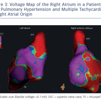 Figure 3 Voltage Map of the Right Atrium in a Patient with Pulmonary Hypertension and Multiple Tachycardias of Right Atrial Origin