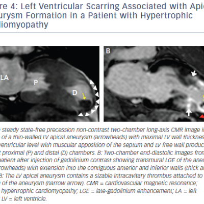 figure -4-left-ventricular