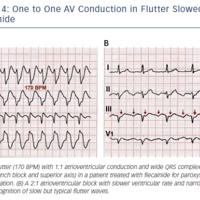 Figure 4 One to One AV Conduction in Flutter Slowed by Flecainide