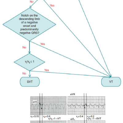 Figure 5 Differential Diagnosis of Wide-QRS Tachycardia using the Vereckei et al. Algorithm